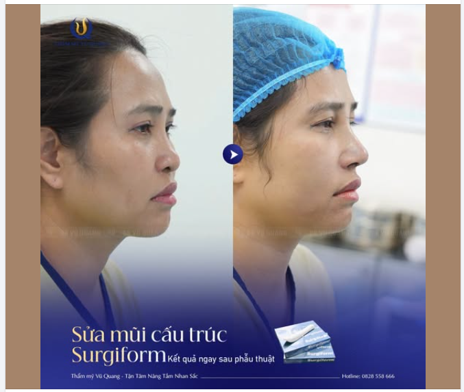 KẾT QUẢ SỬA MŨI CẤU TRÚC NGAY SAU LÀM