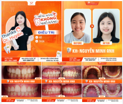 CHÚC MỪNG MINH ANH THÁO NIỀNG THÀNH CÔNG!