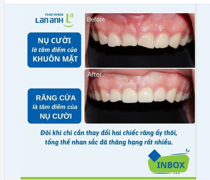 NỤ CƯỜI LÀ TÂM ĐIỂM CỦA KHUÔN MẶT  VÀ RĂNG CỬA LÀ TÂM ĐIỂM CỦA NỤ CƯỜI.