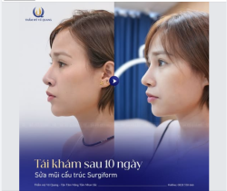 Cả ekip Thẩm mỹ Vũ Quang đều bất ngờ trước vẻ đẹp cá tính, hiện đại của vị khách hàng sau 10 ngày nâng mũi cấu trúc Surgiform.