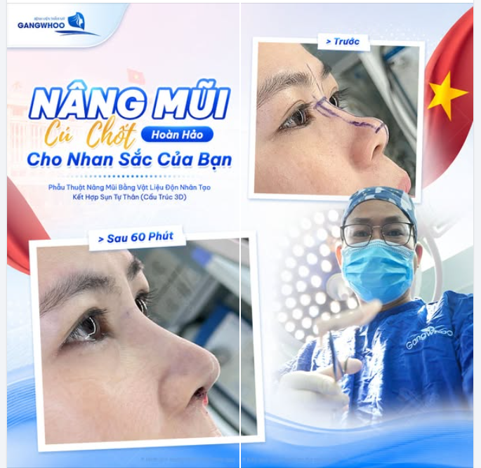 NÂNG MŨI - CÚ CHỐT HOÀN HẢO CHO NHAN SẮC CỦA BẠN
