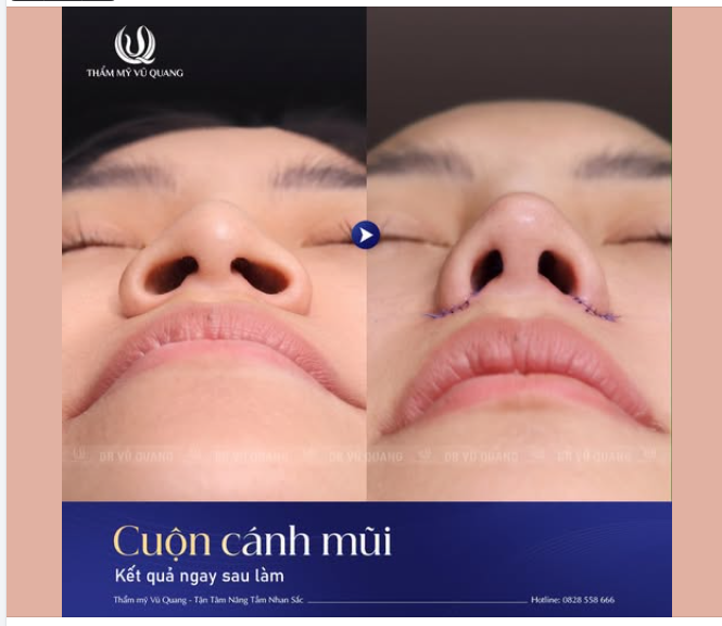 Kết quả thực tế của chị H sau khi thực hiện cuộn cánh mũi tại Thẩm mỹ Vũ Quang.