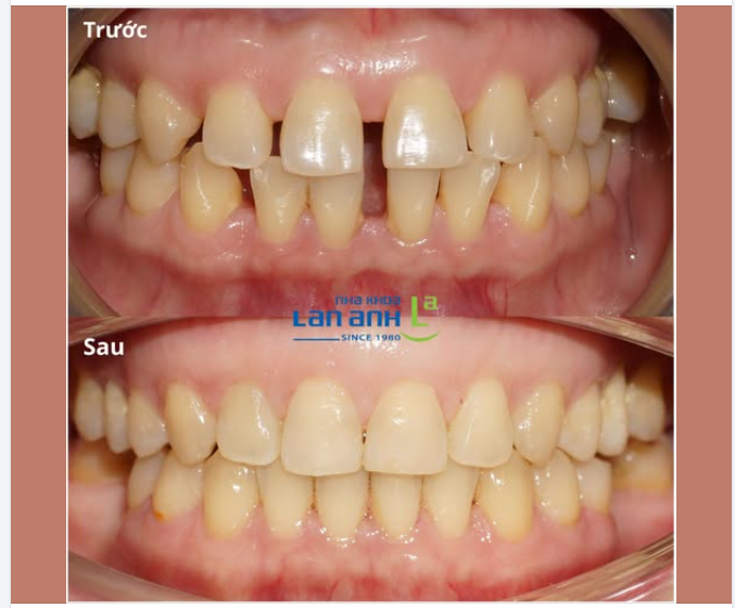 Đóng khe hở - cải thiện khớp cắn - nụ cười hài hòa hơn