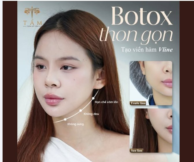 Với các tiêu chí: Hạn chế xâm lấn - Không đau - Không sưng, Botox thon gọn hàm là giải pháp thon gọn hàm không phẫu thuật được ưa chuộng trên toàn thế giới.