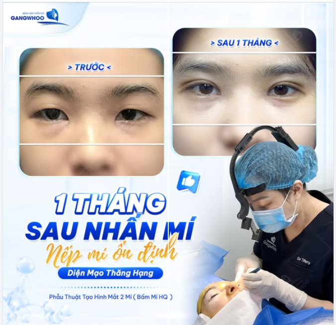 MẮT HAI MÍ - ĐIỂM NHẤN CHO GƯƠNG MẶT CUỐN HÚT