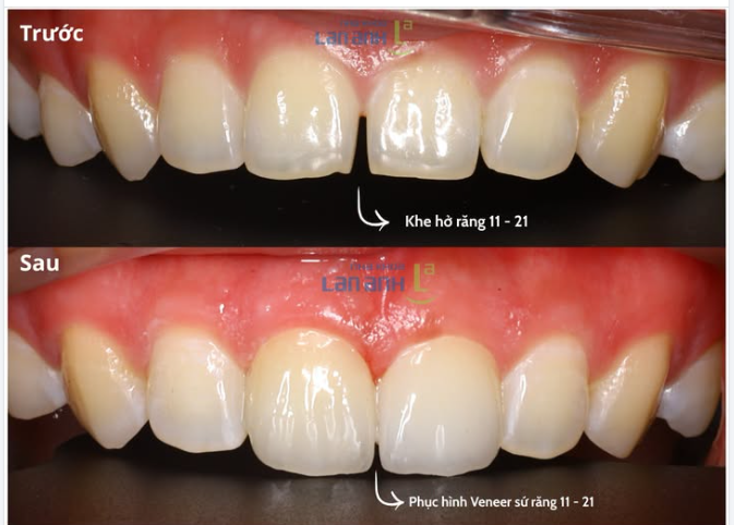 Răng 11 - 21 từng có một khoảng cách… gọi là “cần không gian riêng”.