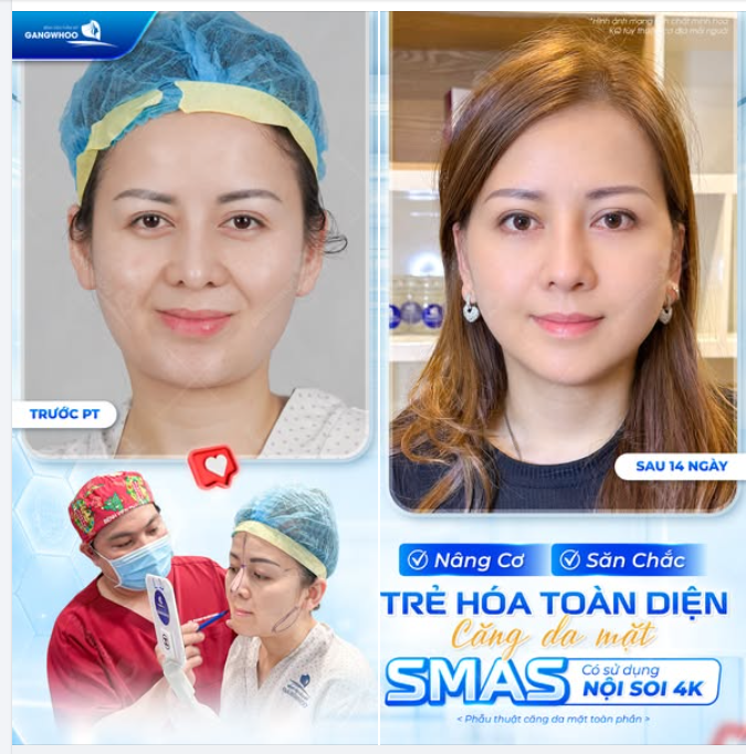 NÂNG CƠ – SĂN CHẮC – TRẺ HÓA TOÀN DIỆN