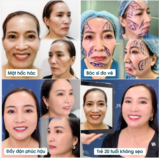 NGỠ NGÀNG BÁC SĨ JW CẤY MỠ MẶT BABY FACE CHO U50 VIỆT KIỀU ĐÀI LOAN TRẺ RA 20 TUỔI HẾT MÁ HÓP, MẶT HỐC HÁC