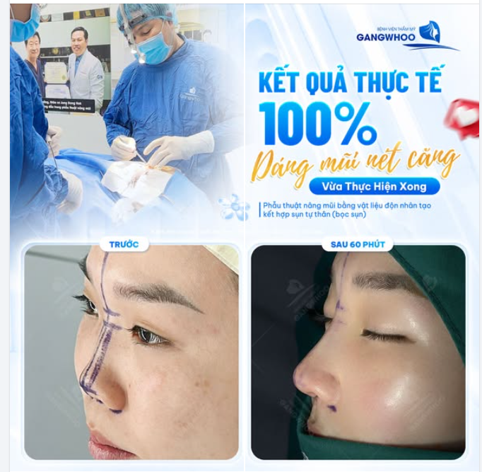 KẾT QUẢ NÂNG MŨI THỰC TẾ TẠI GANGWHOO