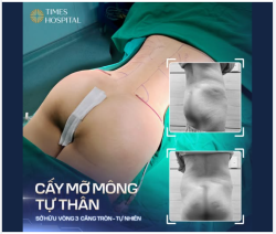 BIẾN MỠ THỪA THÀNH ĐƯỜNG CONG ĐÁNG MƠ ƯỚC