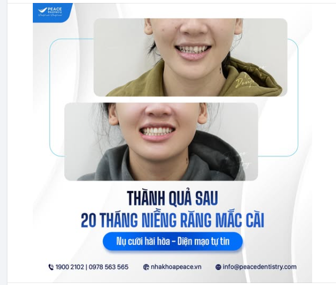 NỤ CƯỜI HÀI HÒA - CẢI THIỆN KHỚP CẮN SAU HÀNH TRÌNH NIỀNG RĂNG