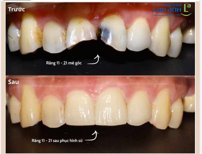 Mẻ một góc răng có thể sửa.  Đừng để vì thế mà ngại cười.