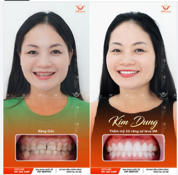 TRẢ LẠI NỤ CƯỜI SÁNG RẠNG RỠ CÙNG TRỌN BỘ 16 RĂNG SỨ LAVA!