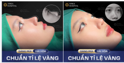 DÁNG MŨI HÀI HÒA - CHUẨN TỈ LỆ VÀNG
