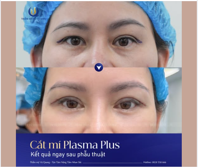 Công nghệ Cắt mí PlasmaPlus luôn mang lại sự khác biệt vượt trội.