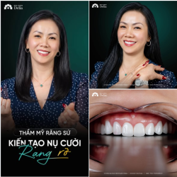 NỤ CƯỜI RẠNG RỠ – DẤU ẤN CÙNG NHA KHOA DELIA