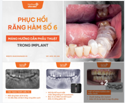 ĐẶT SỰ TỈ MỈ CAO VỚI CÁC CA ĐIỀU TRỊ MẤT RĂNG LÂU NĂM