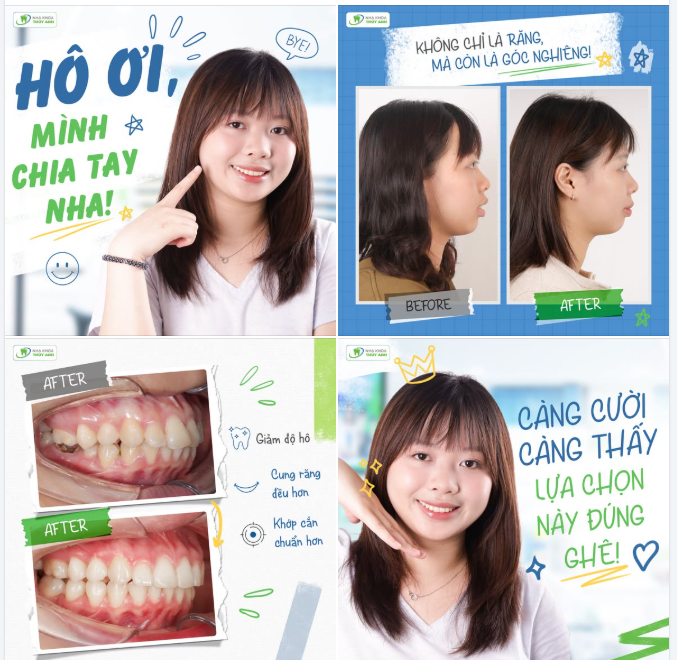 “CHIA TAY” HÔ VÀ CẢ KHOẢNG TRỐNG RĂNG 6 SAU NIỀNG