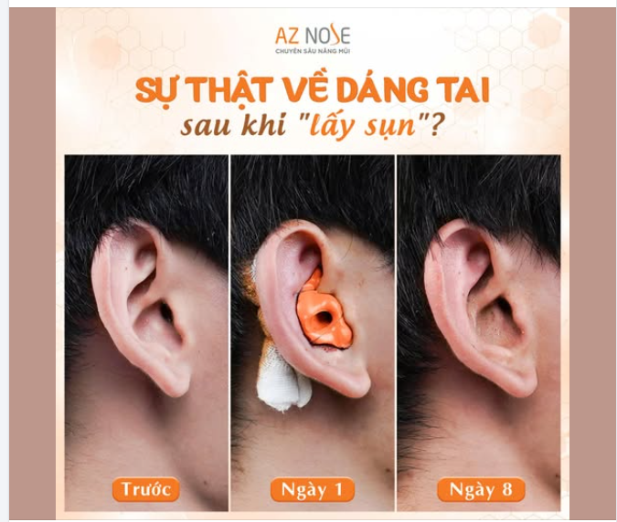 "Lấy sụn" KHÔNG đồng nghĩa với việc dáng tai sẽ bị thay đổi!