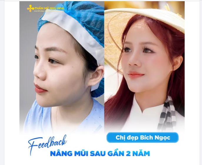 Từ sống mũi thấp, đầu mũi hơi to đến dáng mũi tự nhiên, đầu mũi thon gọn sau gần 2 năm