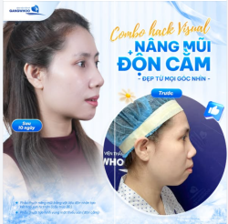 COMBO HACK VISUAL ĐỈNH CAO