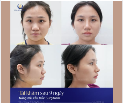 Mũi đẹp chuẩn nét cho y bác sĩ tương lai – Chỉ sau 9 ngày!