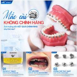 MẮC CÀI KHÔNG CHÍNH HÃNG CÓ THỂ ẢNH HƯỞNG ĐẾN KẾT QUẢ CHỈNH NHA NHƯ THẾ NÀO?