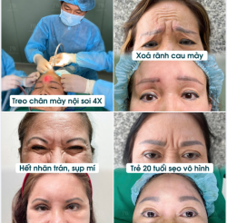 BÁC SĨ TÚ DUNG TREO CHÂN MÀY NỘI SOI 4X GIÚP U50-U70 XOÁ 90% CAU MÀY, NHĂN TRÁN