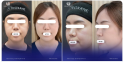 TEOXANE – BÍ KÍP GIỮ GÌN GƯƠNG MẶT KHÔNG TUỔI