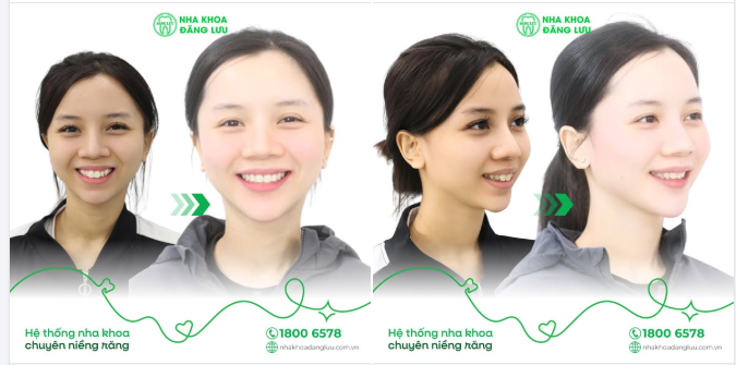 KIÊN TRÌ 3 NĂM VÀ GÓC NGHIÊNG XUẤT SẮC SAU NIỀNG