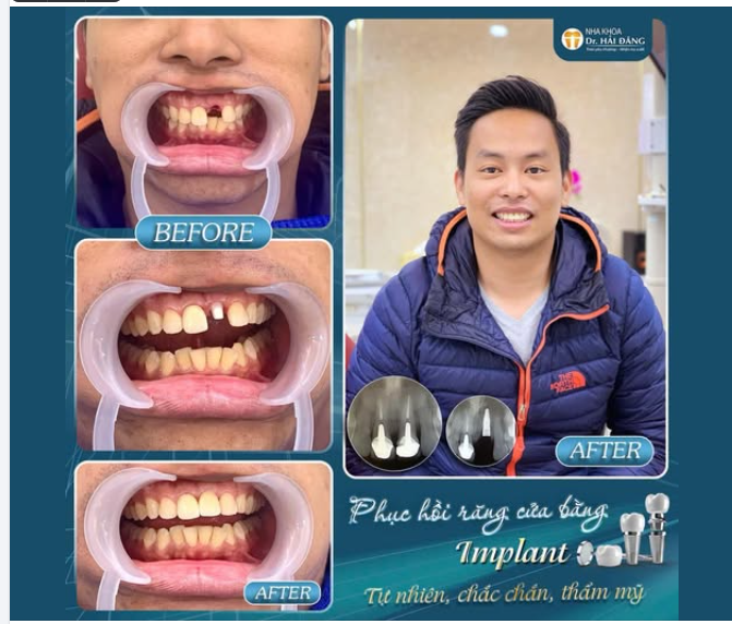 PHỤC HỒI RĂNG CỬA BẰNG IMPLANT – TỰ NHIÊN - CHẮC CHẮN - THẨM MỸ