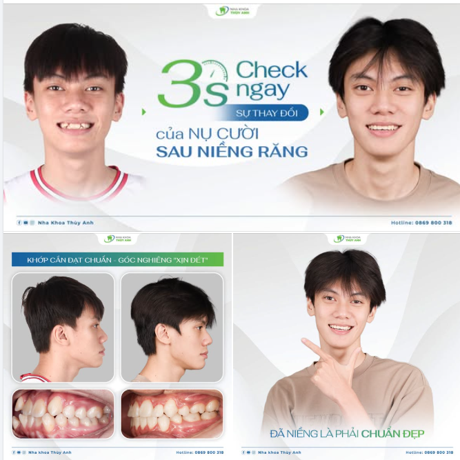 3S CHECK NGAY KẾT QUẢ NIỀNG RĂNG SIÊU KHẤP KHỂNH