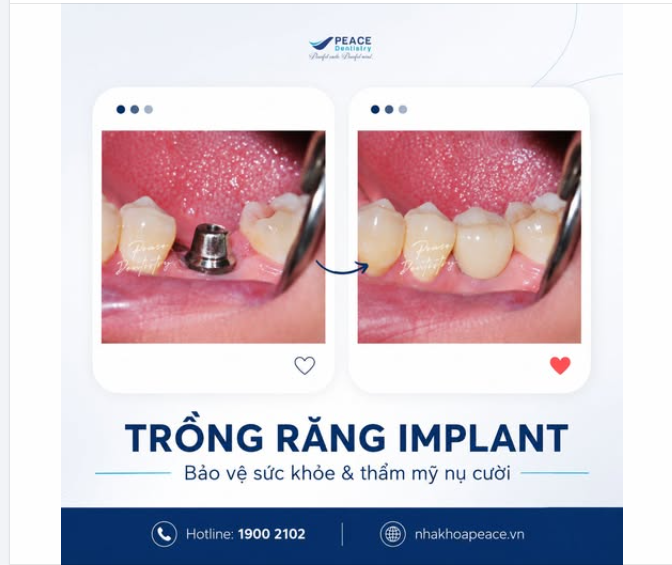 Một chiếc răng mất có thể là khởi đầu của hàng loạt thay đổi mà bạn không dễ nhận ra: ăn nhai kém, răng xô lệch và tiêu xương hàm theo thời gian.