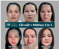 BỎ BỌNG MỠ, HẾT MÍ SỤP U60 MIỀN TÂY CÓ MẮT TRẺ 20 TUỔI SAU THỰC HIỆN COMBO TRẺ HOÁ MẮT TẠI JW