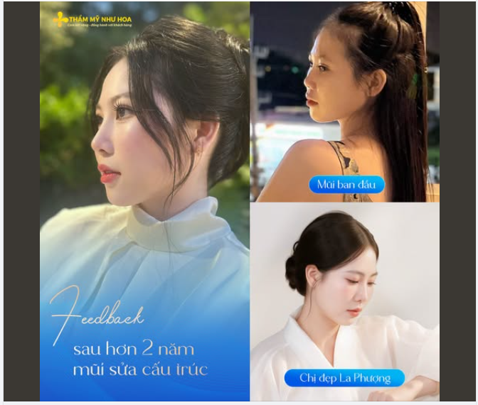 Từng nghĩ nâng mũi chỉ collagen sẽ nhẹ nhàng hơn, nhưng chị đẹp La Phượng lại phải mất thêm một lần để tìm được dáng mũi mình thật sự mong muốn.