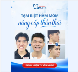 TẠM BIỆT HÀM MÓM – NÂNG CẤP THẦN THÁI!