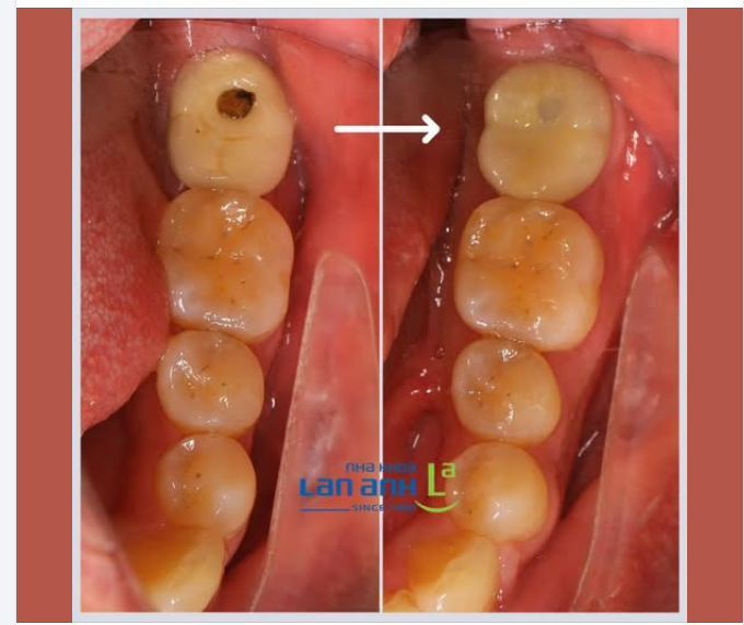 Một chiếc Implant tốt có thể đồng hành rất lâu. Điều cần thay đôi khi chỉ là mão sứ.