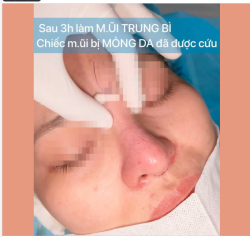MŨI LỘ SỤN, SỤP CHÓP VÀ DA MỎNG SAU NÂNG MŨI NHIỀU NĂM CÓ SỬA ĐƯỢC KHÔNG?