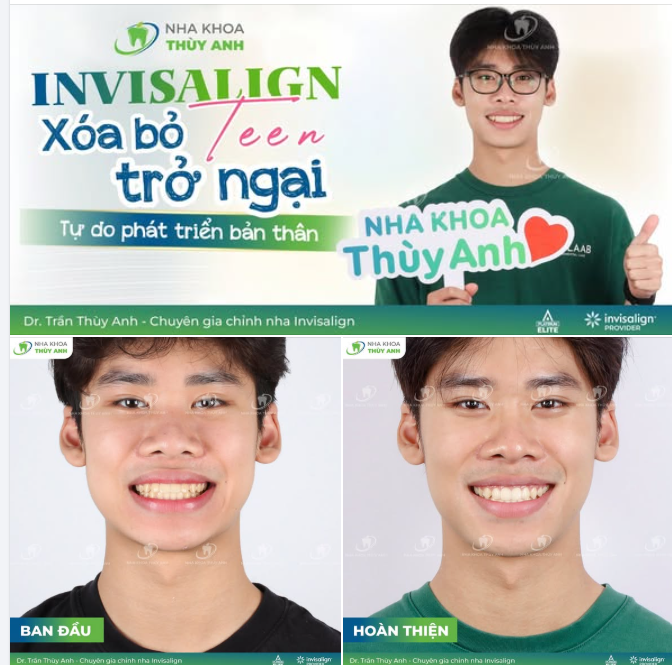 BÍ KÍP CHO NĂM HỌC MỚI: TỰ TIN TỎA SÁNG CÙNG INVISALIGN