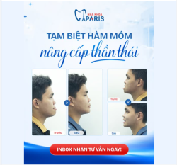 TẠM BIỆT KHỚP CẮN NGƯỢC – TÂN TRANG GÓC NGHIÊNG CHUẨN TỶ LỆ!