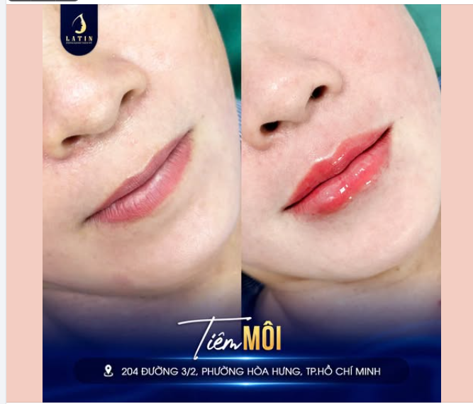 Chỉ với 1ml filler Hàn, đôi m.ôi đã được bổ sung độ đầy đúng vị trí, viền m.ôi rõ hơn và tổng thể trở nên căng mọng mà không tạo cảm giác dày nặng.
