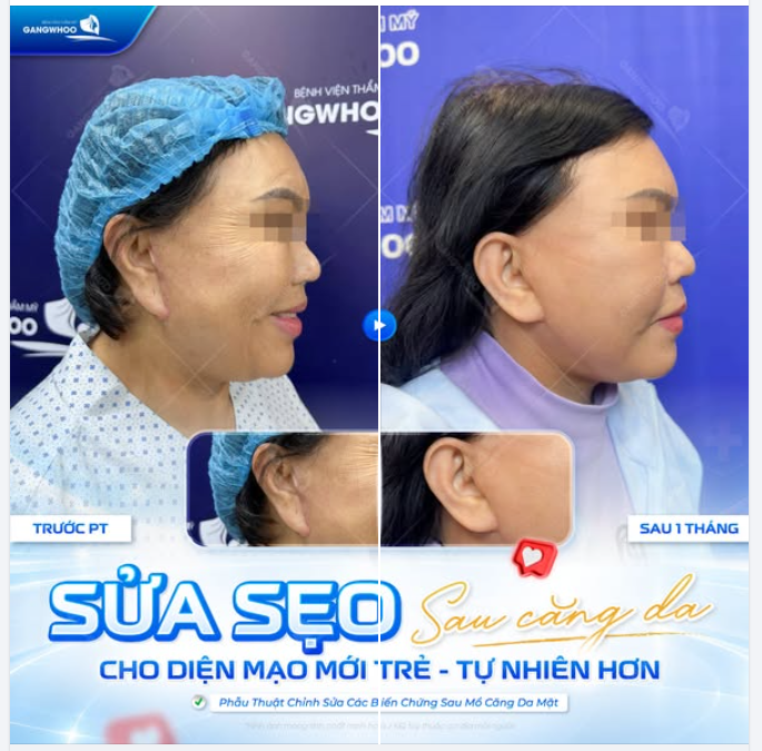 SỬA SẸO SAU CĂNG DA - CHO DIỆN MẠO MỚI TRẺ TỰ NHIÊN HƠN