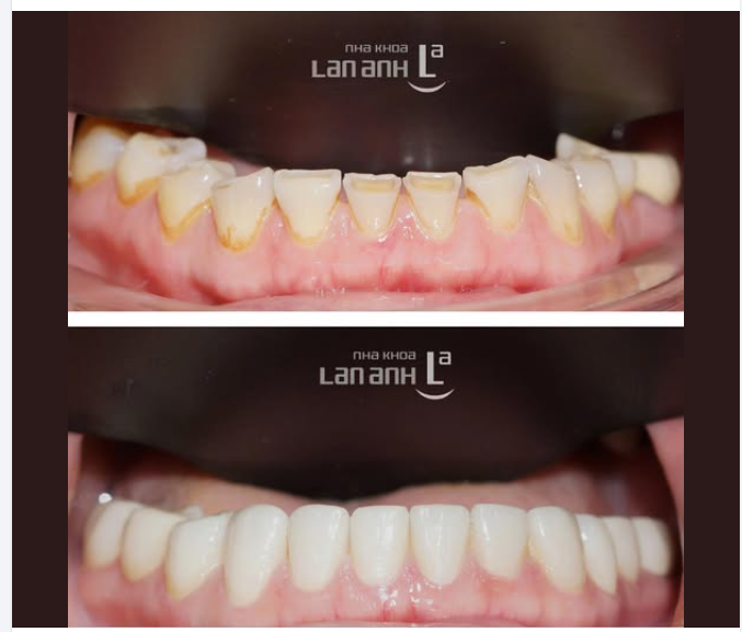 RĂNG MÒN KHÔNG CHỈ LÀ VẤN ĐỀ THẨM MỸ