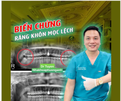 NHỮNG BIẾN CHỨNG DO RĂNG KHÔN MỌC LỆCH VÀ CÁCH XỬ TRÍ