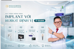 QUY TRÌNH TRỒNG RĂNG IMPLANT KHÔNG ĐAU VỚI ROBOT ĐỊNH VỊ X-GUIDE