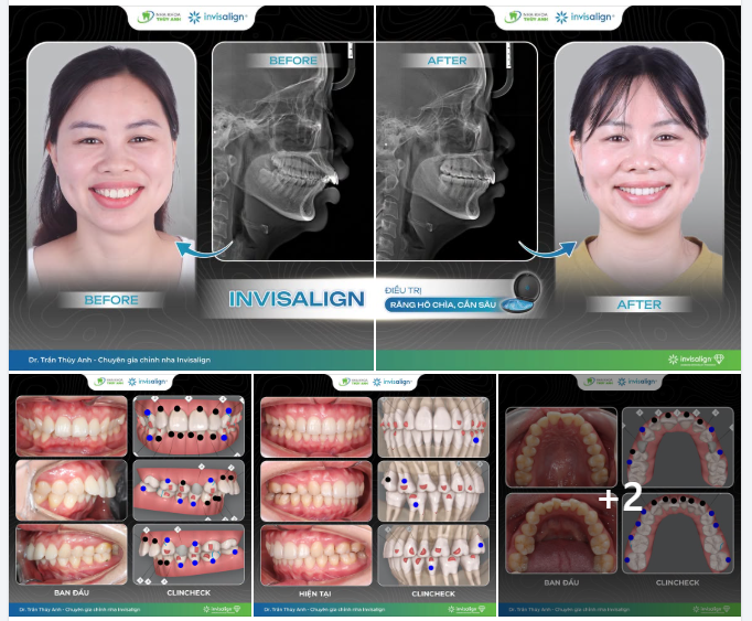 INVISALIGN ĐIỀU TRỊ SAI KHỚP CẮN HẠNG II CÓ ĐỘ HÔ CHÌA LỚN