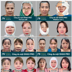 CĂNG DA MẶT SMAS PRO KHIẾN HƠN 1000+ CHỊ EM TRẺ 20 TUỔI, SẸO VÔ HÌNH, ĐẸP VĨNH VIỄN