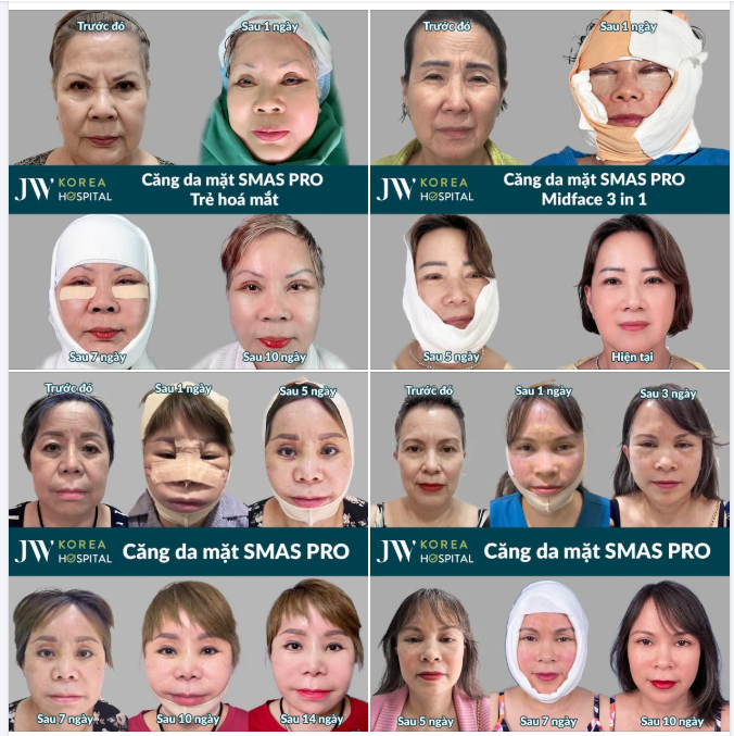CĂNG DA MẶT SMAS PRO KHIẾN HƠN 1000+ CHỊ EM TRẺ 20 TUỔI, SẸO VÔ HÌNH, ĐẸP VĨNH VIỄN