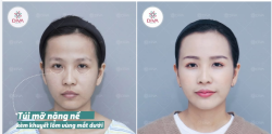 Bọng mắt nặng nề và khuyết lõm vùng mắt dưới sẽ ảnh hưởng thế nào đến thần thái khuôn mặt?