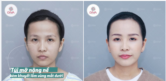 Bọng mắt nặng nề và khuyết lõm vùng mắt dưới sẽ ảnh hưởng thế nào đến thần thái khuôn mặt?